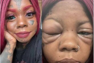Mother Going Blind After Tattooing Her Eyeballs Blue And Purple To Copy An Influencer