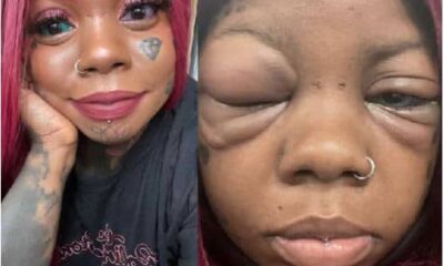 Mother Going Blind After Tattooing Her Eyeballs Blue And Purple To Copy An Influencer