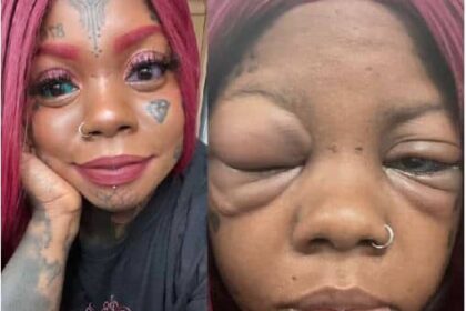 Mother Going Blind After Tattooing Her Eyeballs Blue And Purple To Copy An Influencer