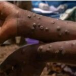 Mpox spreads across five Benue LGAs with 31 confirmed cases