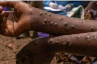 Mpox spreads across five Benue LGAs with 31 confirmed cases
