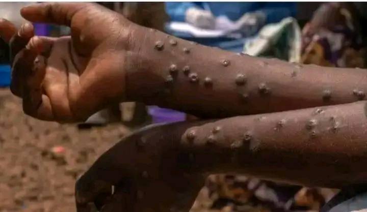 Mpox spreads across five Benue LGAs with 31 confirmed cases
