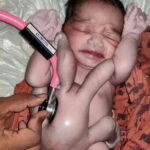 Unbelievable! Check Out Photos Of The Baby Who Was Born With Four Arms And Four Legs