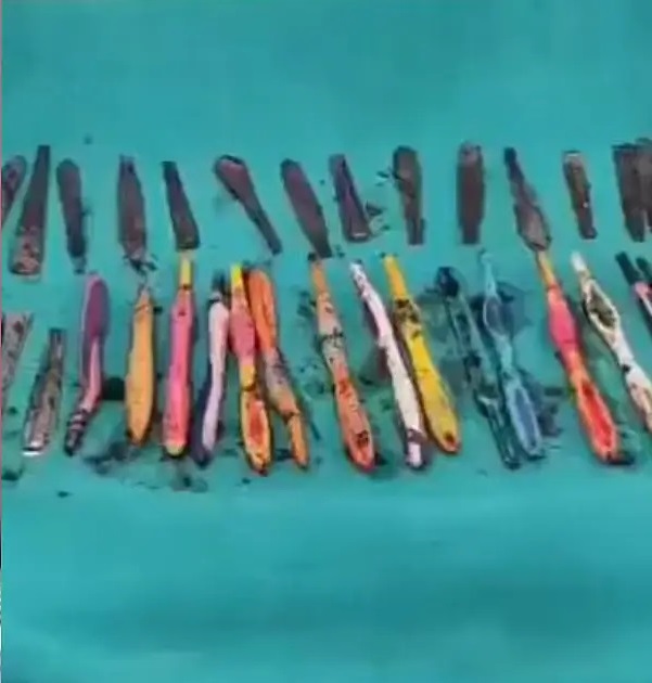 Doctors remove 29 spoons, 19 toothbrushes, and pens from a Drug addict’s stomach
